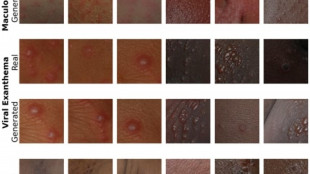 Malattie pelle, da UniBo Ai più equa per diagnosi più inclusiva