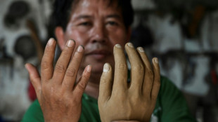 Indonesian leprosy survivor crafts new limbs for shunned villagers